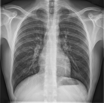 chest x-ray